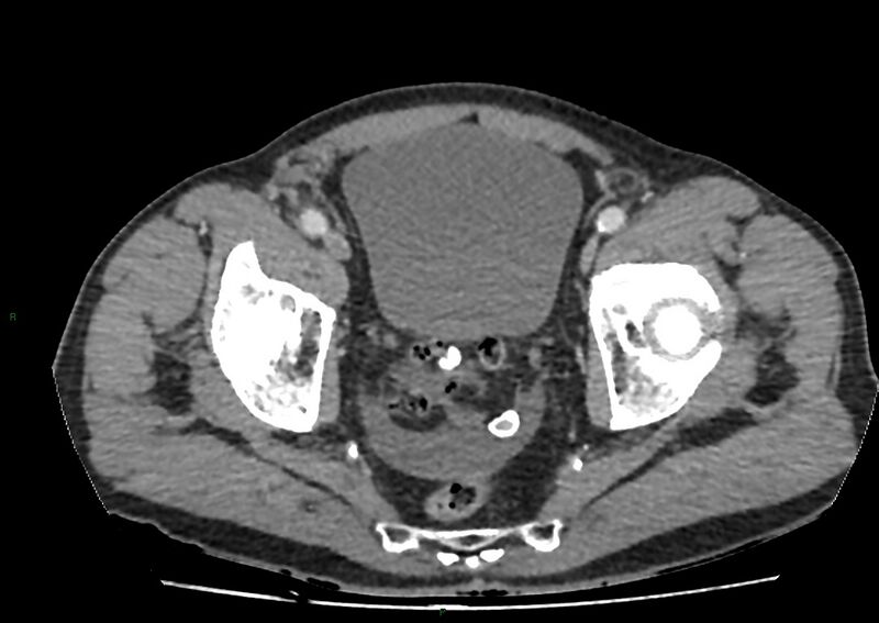 File:Closed loop small bowel obstruction with ischemia (Radiopaedia 84180-99456 A 107).jpg
