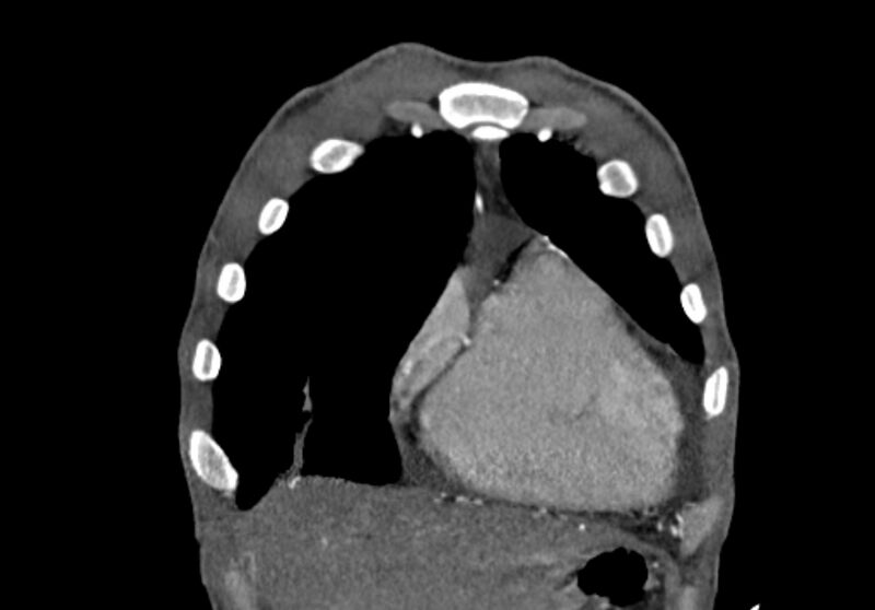 File:Coarctation of aorta with aortic valve stenosis (Radiopaedia 70463-80574 C 22).jpg