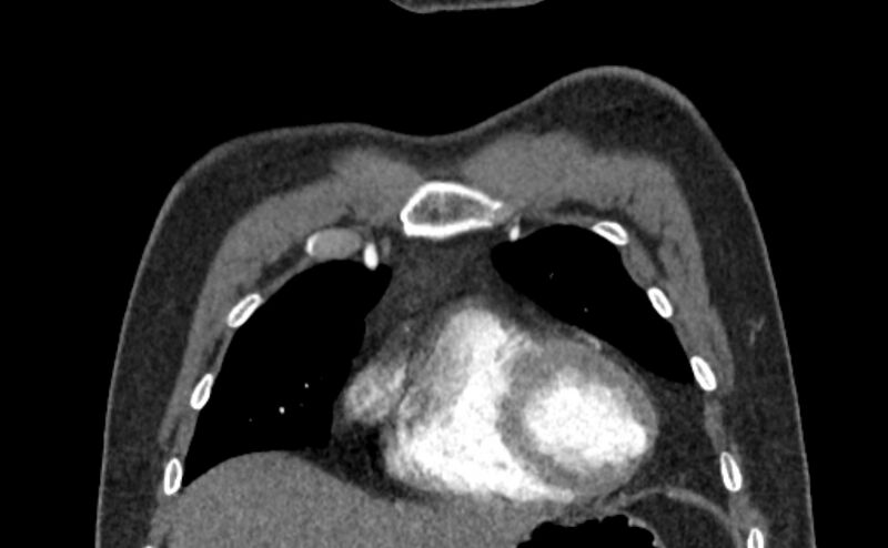 File:Coarctation of the aorta (Radiopaedia 53363-59343 C 12).jpg