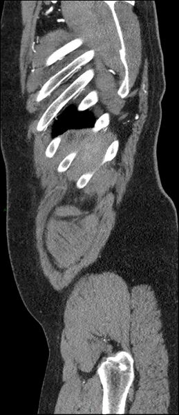 File:Coarctation of the aorta (Radiopaedia 74632-88521 C 306).jpg
