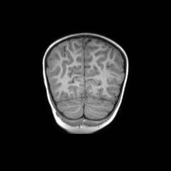 File:Cochlear nerve aplasia - unilateral (Radiopaedia 87910-104413 Coronal T1 44).jpg