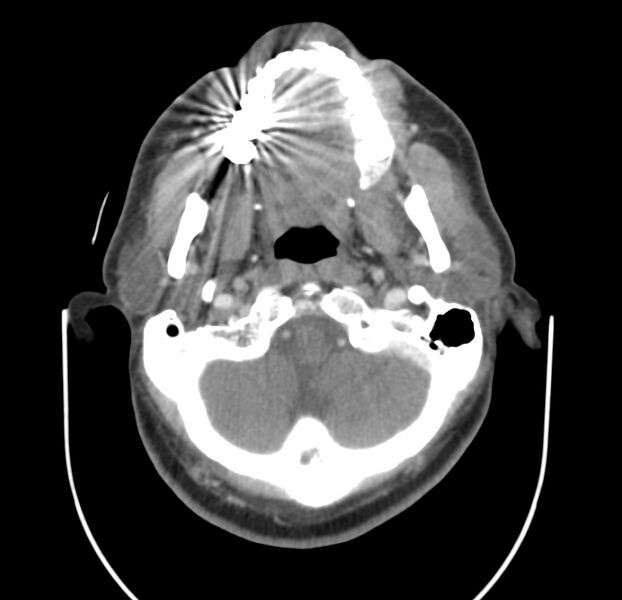 File:Colloid cyst of thyroid (Radiopaedia 22897-22923 Axial C+ delayed 18).jpg