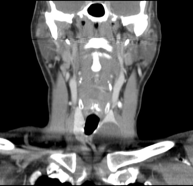 File:Colloid cyst of thyroid (Radiopaedia 22897-22923 Coronal C+ delayed 29).jpg