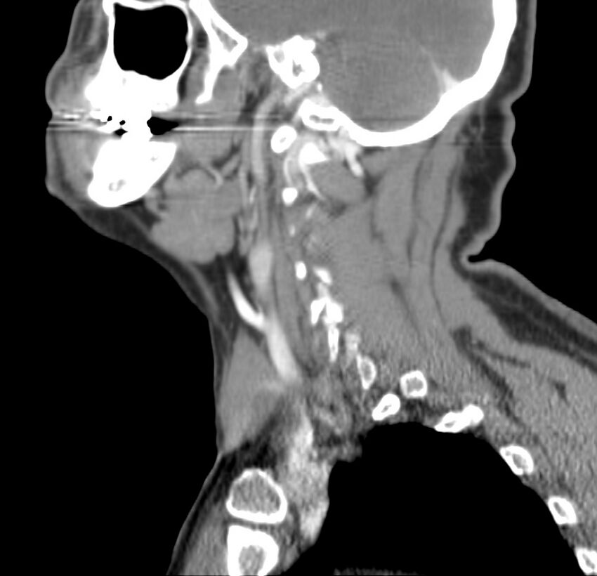 Colloid cyst of thyroid (Radiopaedia 22897-22923 Sagittal C+ delayed 40).jpg