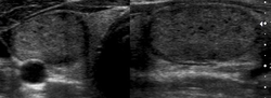 Ultrasound: halo sign of thyroid nodule
