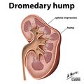 Dromedary hump - illustration (Radiopaedia 27943).jpg