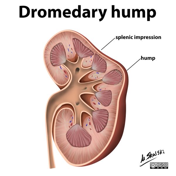 File:Dromedary hump - illustration (Radiopaedia 27943).jpg