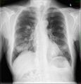 Lung metastases (Radiopaedia 72076).jpg