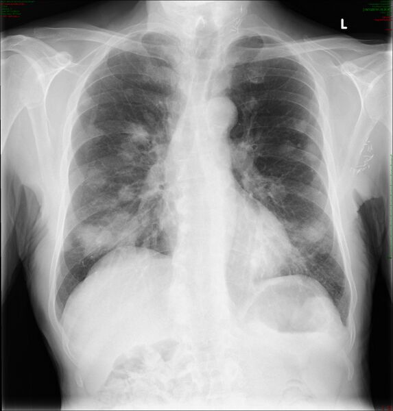 File:Lung metastases (Radiopaedia 72076).jpg