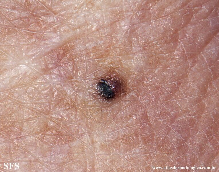 File:Melanoma (Dermatology Atlas 101).jpg