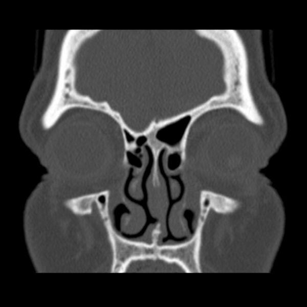 File:Nasolabial cyst (Radiopaedia 33987-35205 Coronal bone window 27).jpg