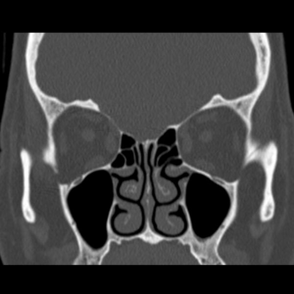 File:Nasolabial cyst (Radiopaedia 33987-35205 Coronal bone window 38).jpg
