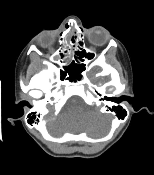 File:Nasoorbitoethmoid fracture (Radiopaedia 90044-107205 Axial non-contrast 147).jpg