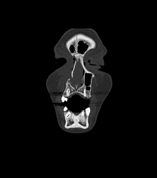 File:Nasoorbitoethmoid fracture (Radiopaedia 90044-107205 Coronal bone window 29).jpg