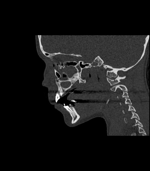 File:Nasoorbitoethmoid fracture (Radiopaedia 90044-107205 Sagittal bone window 88).jpg
