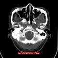 Nasopharyngeal carcinoma recurrence - skull base destruction (Radiopaedia 29107-29491 A 8).jpg