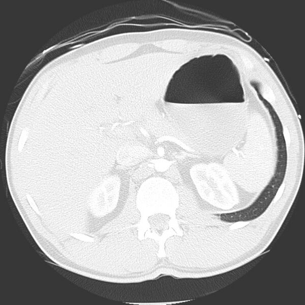 File:Near drowning pulmonary edema (Radiopaedia 16868-16591 Axial lung window 56).jpg