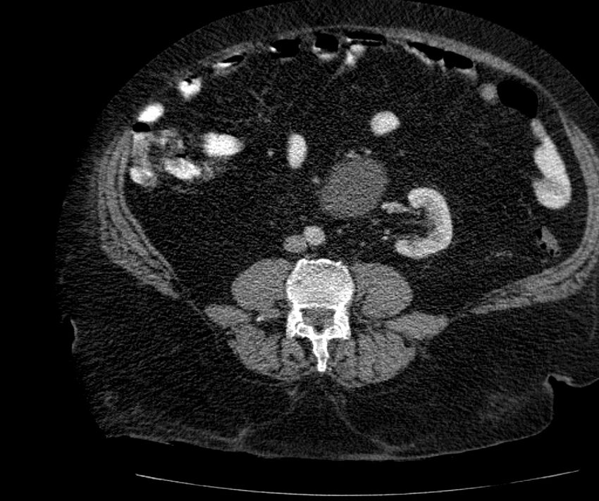 Nephroptosis with inguinal hernia containing perirenal fat (Radiopaedia 56632-63391 C 204).jpg