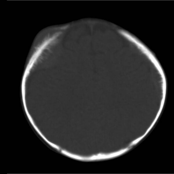 File:Neuroblastoma with skull metastases (Radiopaedia 30326-30958 Axial bone window 16).jpg