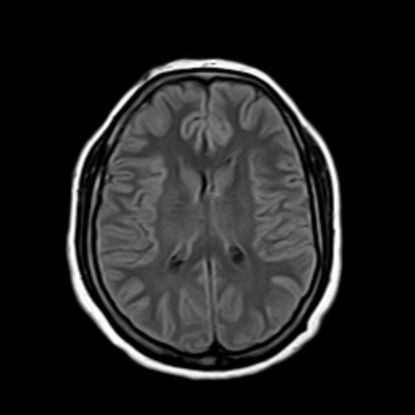 File:Neurofibromatosis type 2 (Radiopaedia 67470-76871 Axial FLAIR 14).jpg