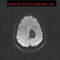Neuroglial cyst (Radiopaedia 10713-11184 Axial DWI 29).jpg