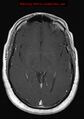 Neuroglial cyst (Radiopaedia 10713-11184 Axial T1 C+ 13).jpg