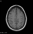 Neurosarcoidosis (Radiopaedia 10930-11351 Axial T1 15).jpg