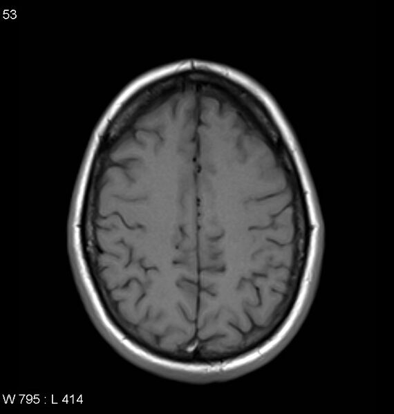 File:Neurosarcoidosis (Radiopaedia 10930-11351 Axial T1 15).jpg