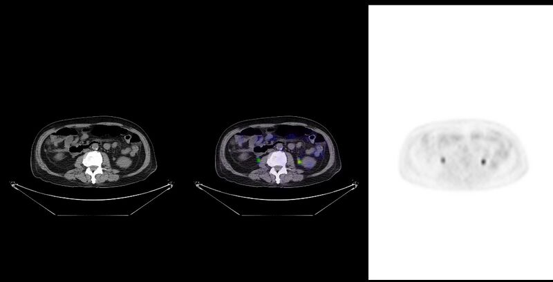 File:Non-Hodgkin lymphoma involving seminal vesicles with development of interstitial pneumonitis during Rituximab therapy (Radiopaedia 32703-33761 ax CT Fus PET 38).jpg