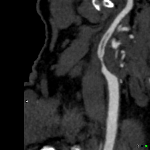 File:Non-occlusive intraluminal internal carotid artery thrombus (Radiopaedia 37751-39658 A 15).jpg