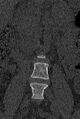 Normal CT lumbar spine (Radiopaedia 53981-60118 Coronal bone window 5).jpg