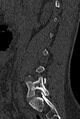 Normal CT lumbar spine (Radiopaedia 53981-60118 Sagittal bone window 25).jpg