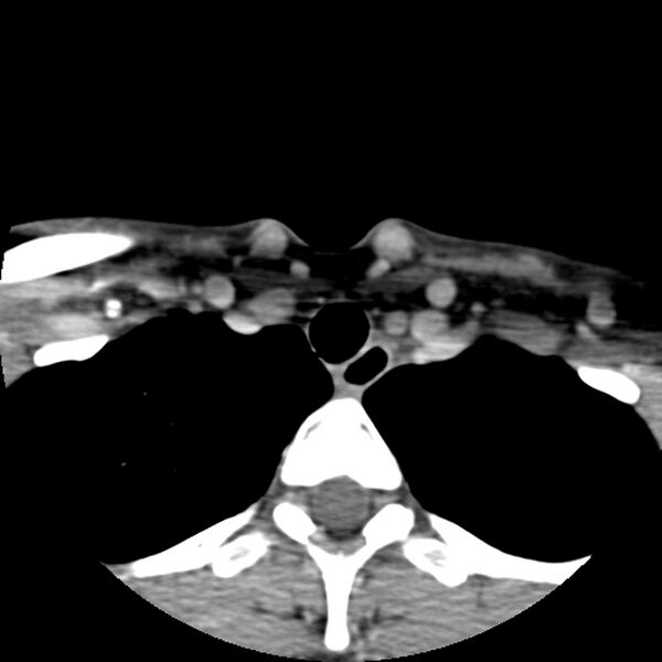 File:Normal CT of the neck (Radiopaedia 14575-14500 Axial C+ 64).jpg