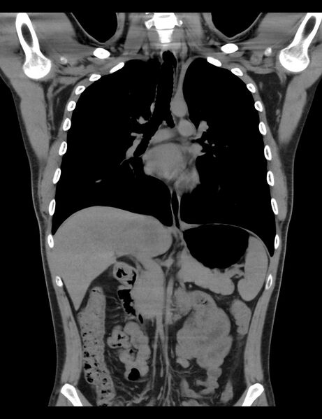 File:Normal CT virtual gastroscopy (Radiopaedia 29960-30501 E 7).jpg