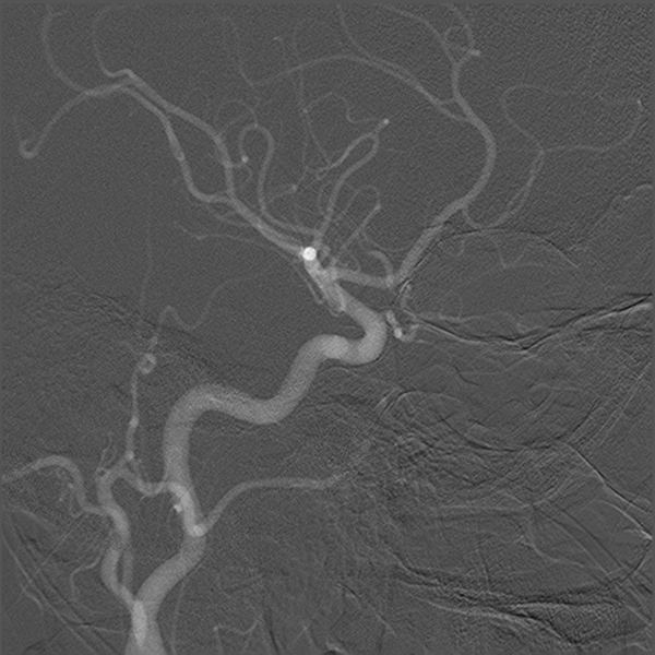 File:Normal cerebral angiogram (four vessel DSA) (Radiopaedia 41708-44649 I 7).png