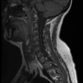 Normal cervical and thoracic spine MRI (Radiopaedia 35630-37156 Sagittal T1 4).png