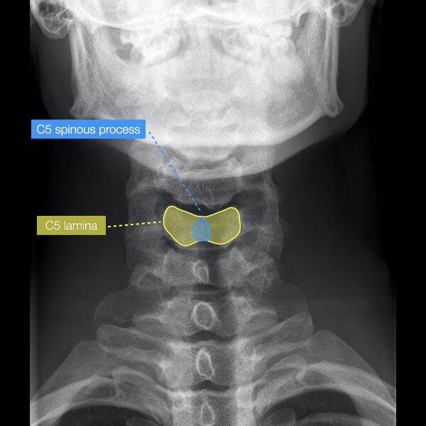 File:Normal cervical spine radiographs (Radiopaedia 32505-96697 B 4).jpeg