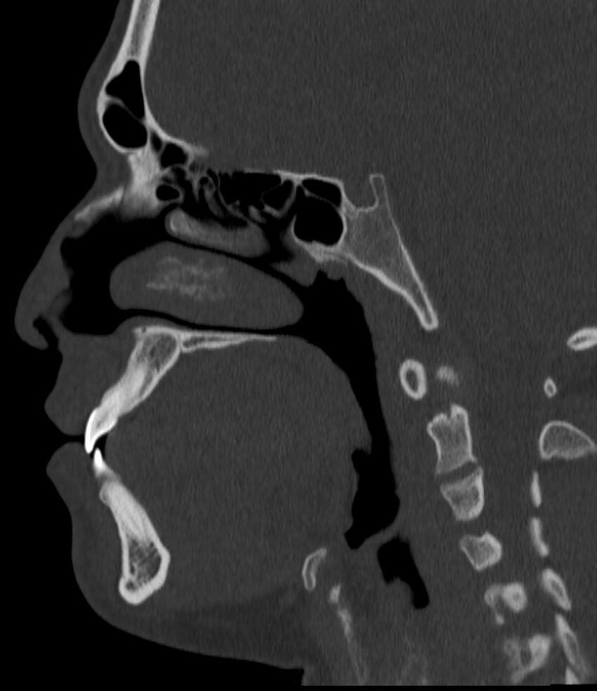 Normal facial bone CT (Radiopaedia 88742-105476 Sagittal bone window 82).jpg