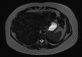 Normal liver MRI with Gadolinium (Radiopaedia 58913-66163 E 27).jpg