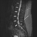 Normal lumbar spine MRI (Radiopaedia 47857-52609 Sagittal STIR 9).jpg
