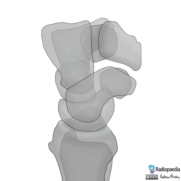 File:Normal wrist alignment, dorsal and volar intercalated segmental instability (illustration) (Radiopaedia 80949-94490 A 1).png