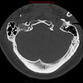 Occipital condyle fracture (Radiopaedia 18366-18208 Axial bone window 7).jpg