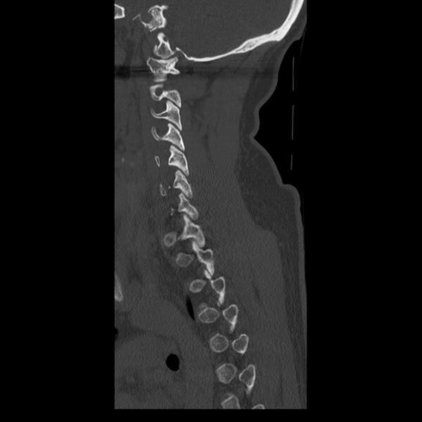 File:Occipital condyle fracture (Radiopaedia 31755-32691 Sagittal bone window 30).jpg