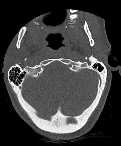 File:Occipital condyle fracture (Radiopaedia 61165-69056 D 5).jpg