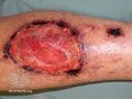 Pyoderma gangrenosum (DermNet NZ doctors-emergencies-images-pyodgan4).jpg