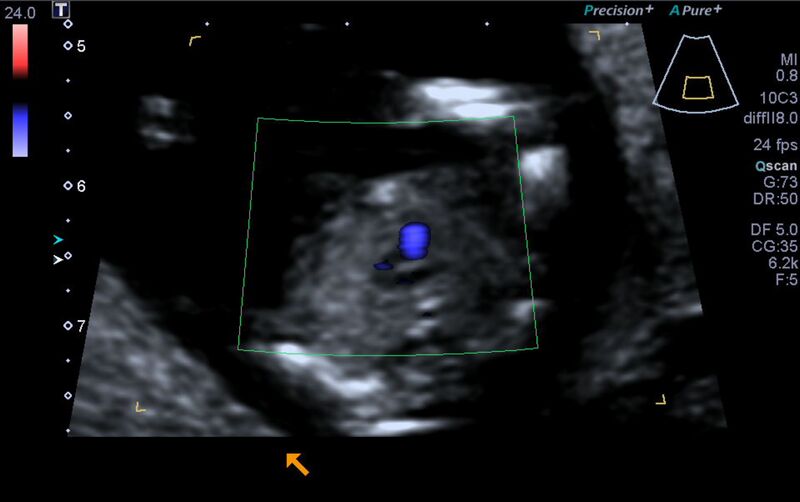 File:1st trimester nuchal-morphology ultrasound (Radiopaedia 44706-48477 Heart views cine with colour 139).jpg