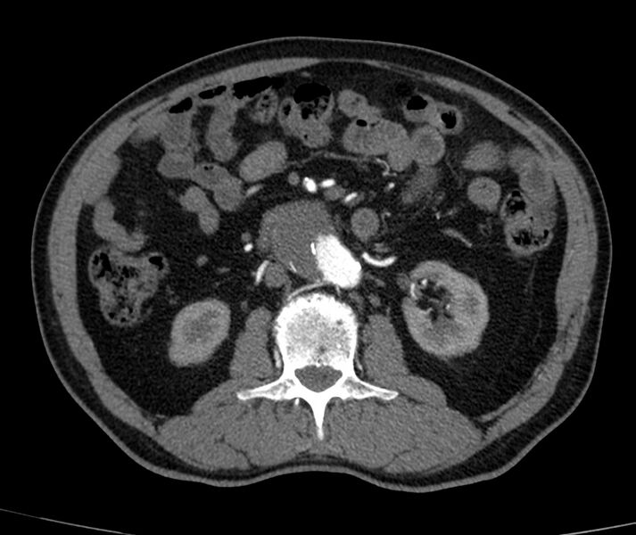 File:Abdominal aortic aneurysm (Radiopaedia 22421-22458 C+ arterial phase 38).jpg