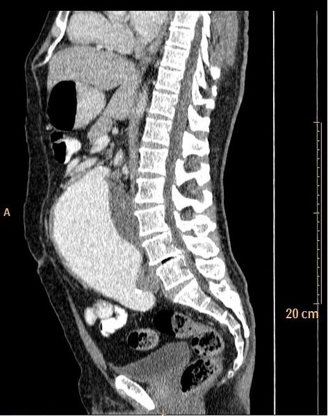 File:Abdominal aortic aneurysm (Radiopaedia 25985-26121 Sagittal C+ arterial phase 16).jpg