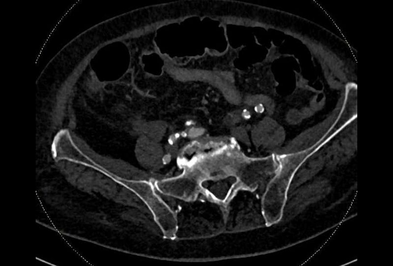 File:Abdominal aortic aneurysm with thrombus fissuration (Radiopaedia 73192-83919 Axial C+ arterial phase 159).jpg