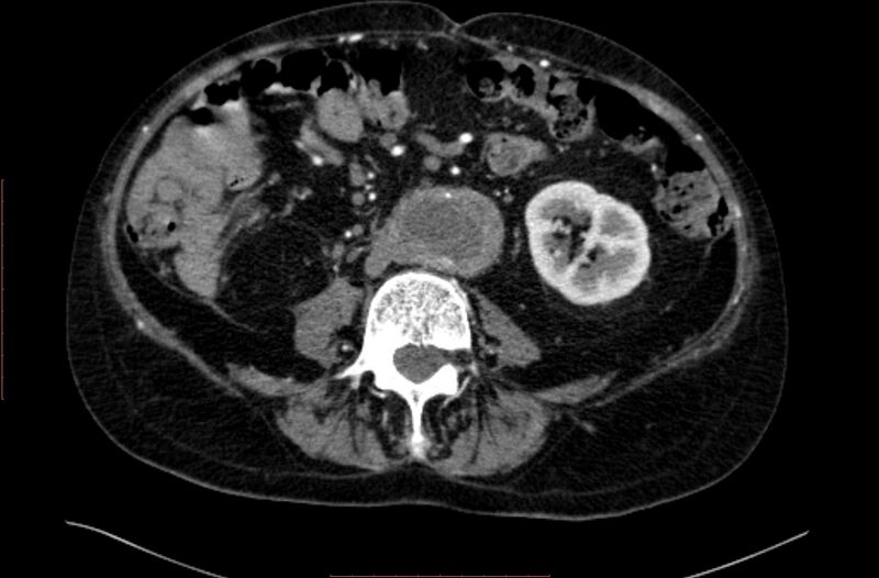 File:Abdominal aortic interposition tube graft and aneurysm thrombosis (Radiopaedia 71438-81857 Axial C+ arterial phase 99).jpg